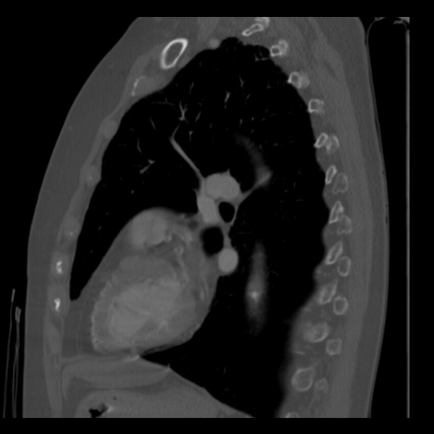 Adenocarcinoma of the lung (Radiopaedia 41015-43755 Sagittal bone window 66).jpg