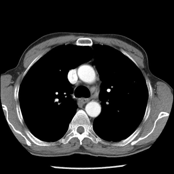 File:Adenocarcinoma of the lung - micropapillary predominant (Radiopaedia 42446-45563 Axial C+ portal venous phase 24).jpg