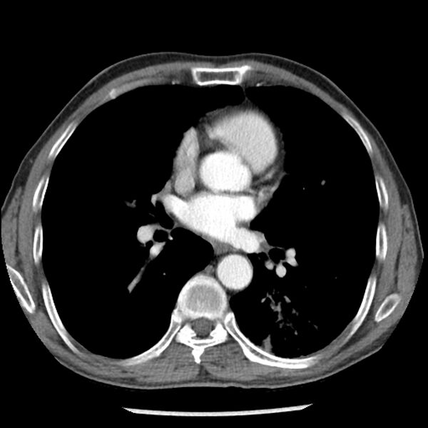 File:Adenocarcinoma of the lung - micropapillary predominant (Radiopaedia 42446-45563 Axial C+ portal venous phase 40).jpg