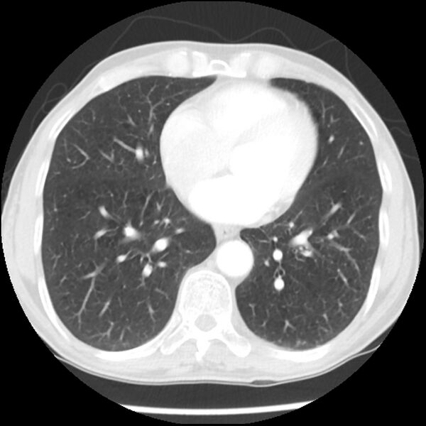 File:Adenocarcinoma of the lung - micropapillary predominant (Radiopaedia 42446-45563 Axial lung window 49).jpg