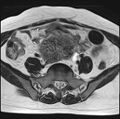 Adenomyosis - ovarian endometriomas (Radiopaedia 67031-76350 Axial T2 6).jpg
