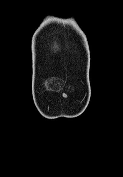 File:Adhesional small bowel obstruction (Radiopaedia 58900-66131 Coronal C+ portal venous phase 49).jpg