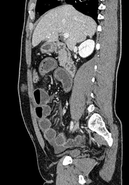 File:Adhesional small bowel obstruction (Radiopaedia 58900-66131 Sagittal C+ portal venous phase 96).jpg