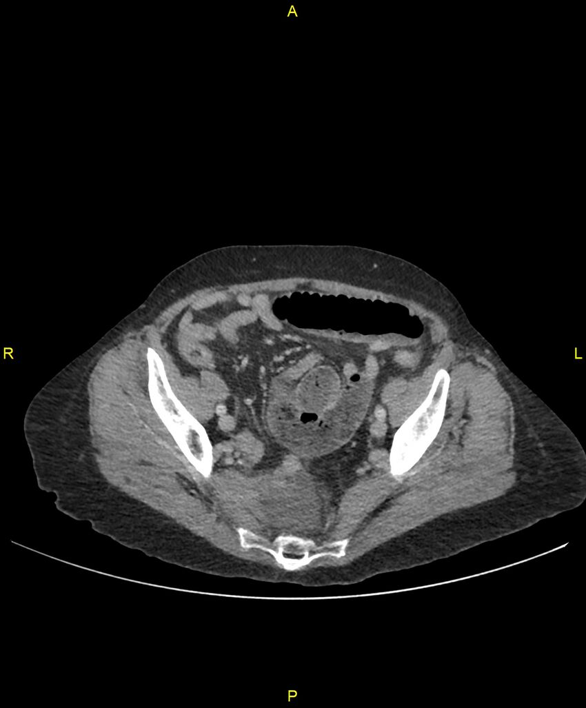 Adhesional small bowel obstruction (Radiopaedia 85402-101024 Axial C+ portal venous phase 231).jpg