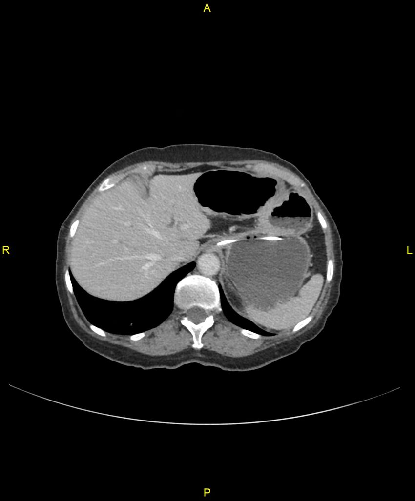 Adhesional small bowel obstruction (Radiopaedia 85402-101024 Axial C+ portal venous phase 54).jpg