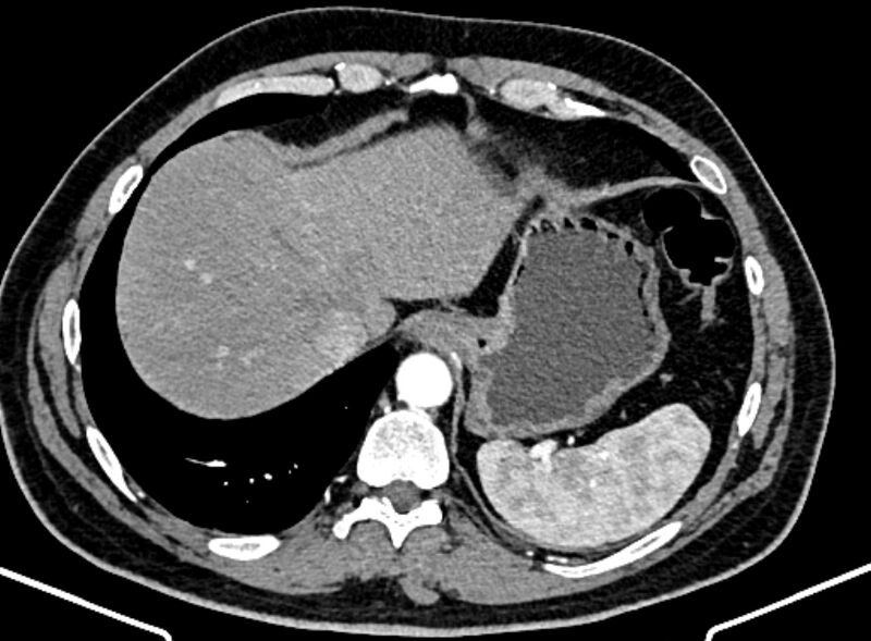 File:Adrenal metastases (Radiopaedia 73082-83791 Axial C+ arterial phase 22).jpg