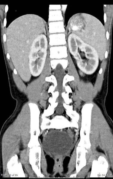 File:Agenesis of the gallbladder (Radiopaedia 55454-61905 A 33).jpg