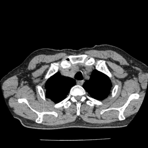 File:Airway foreign body in adult (Radiopaedia 85907-101779 Axial liver window 4).jpg
