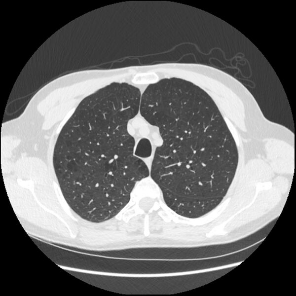 File:Alpha-1-antitrypsin deficiency (Radiopaedia 40993-43722 Axial lung window 49).jpg
