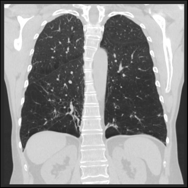 File:Alpha-1-antitrypsin deficiency (Radiopaedia 40993-43722 Coronal lung window 73).jpg