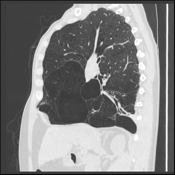 File:Alpha-1-antitrypsin deficiency (Radiopaedia 40993-43722 Sagittal lung window 165).jpg