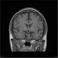 Amnestic syndrome secondary to hypoxic brain injury (Radiopaedia 24743-25004 B 16).jpg