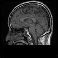 Amnestic syndrome secondary to hypoxic brain injury (Radiopaedia 24743-25004 T1 10).jpg