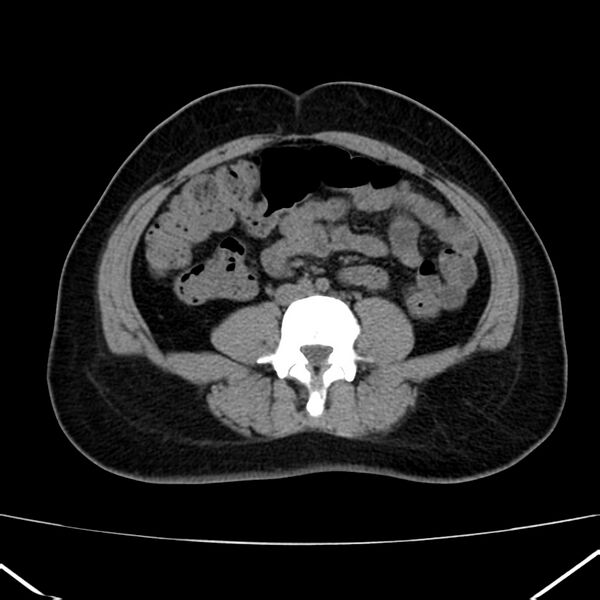 File:Ampullary tumor (Radiopaedia 22787-22816 Axial non-contrast 33).jpg