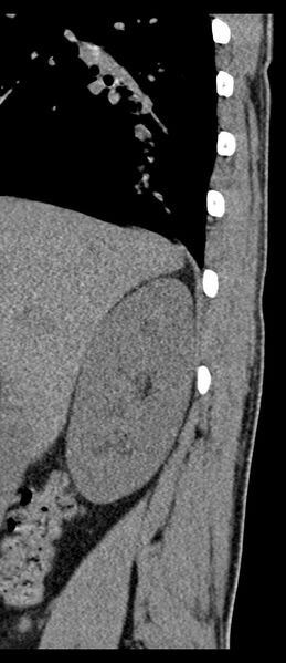 File:Aneurysmal bone cyst T11 (Radiopaedia 29294-29721 E 80).jpg