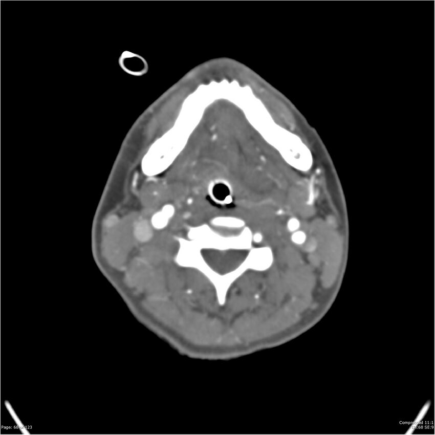 Aneurysmal subarachnoid hemorrhage and Moya Moya disease (Radiopaedia 34306-35593 Axial CT COW 68).jpg