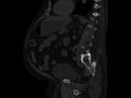 Ankylosing spondylitis (Radiopaedia 44609-48357 Sagittal bone window 66).jpg