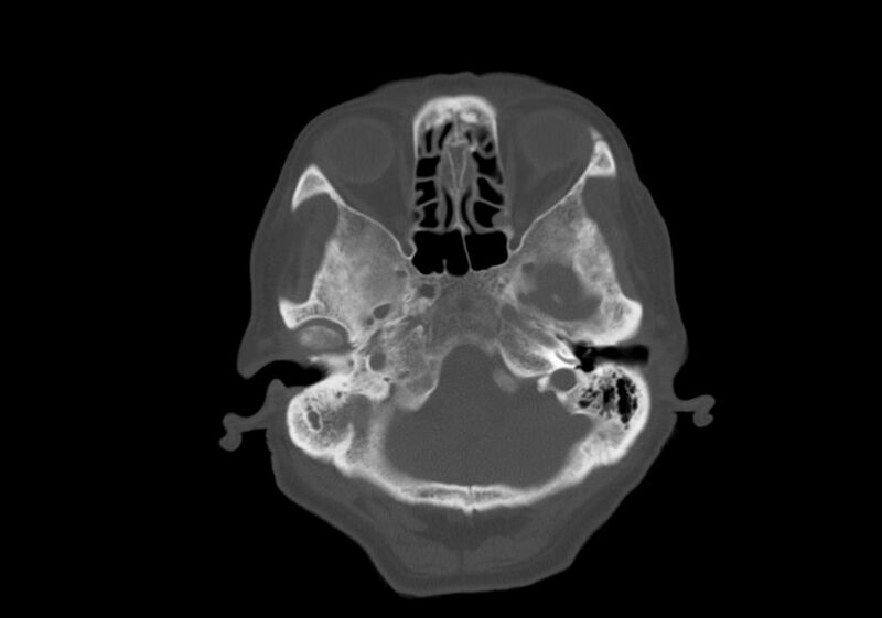 File:Anomalous intracranial venous drainage (Radiopaedia 28161-28418 Axial bone window 6).jpg