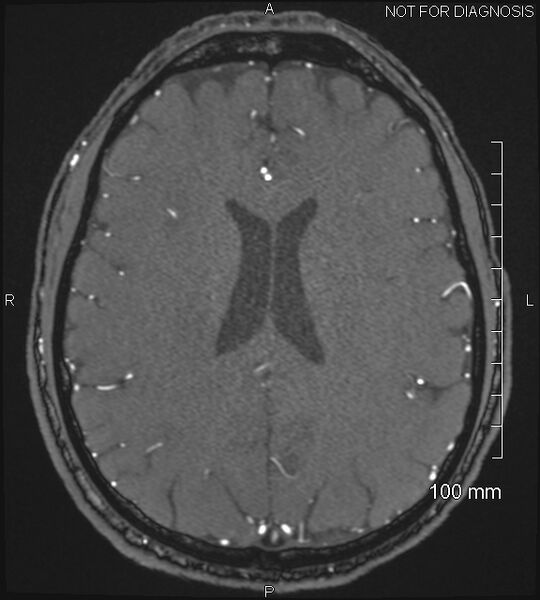 File:Anterior cerebral artery aneurysm (Radiopaedia 80683-94127 Axial MRA 158).jpg