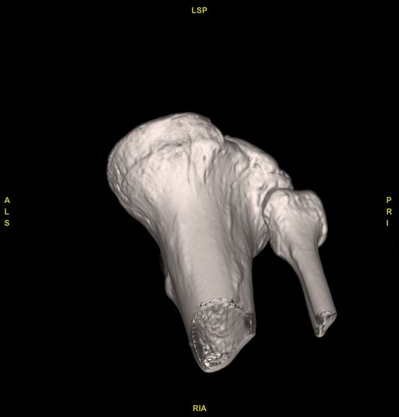 File:Anterior cruciate ligament avulsion fracture (Radiopaedia 58939-66194 VRT 16).jpg