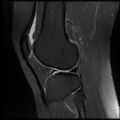 Anterior cruciate ligament tear, Wrisberg rip and bucket-handle tear of medial meniscus (Radiopaedia 75872-87266 Sagittal PD fat sat 8).jpg