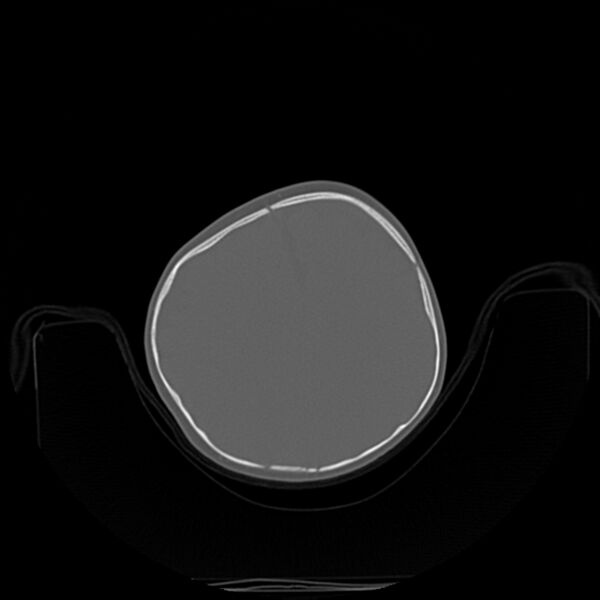 File:Anterior plagiocephaly (Radiopaedia 71836-82273 C 61).jpg