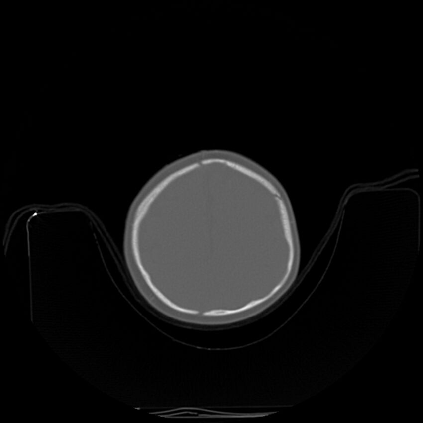 Anterior plagiocephaly (Radiopaedia 71836-82273 C 84).jpg