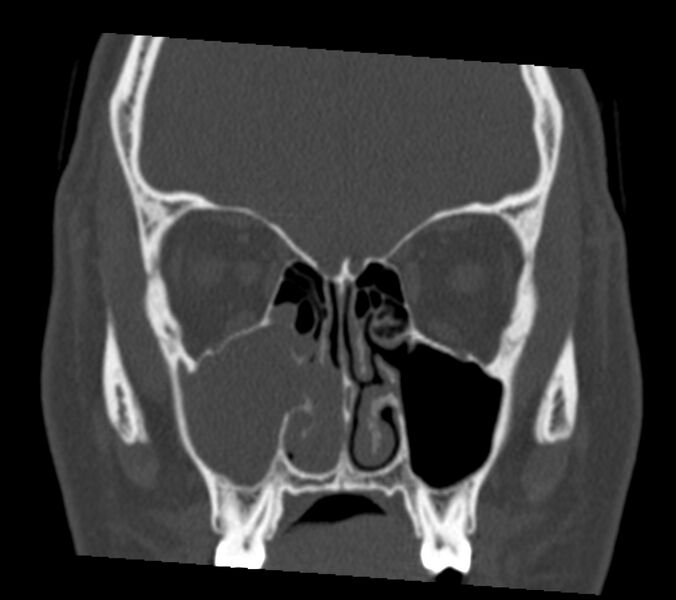 File:Antrochoanal polyp (Radiopaedia 21894-21868 Coronal bone window 14).jpg