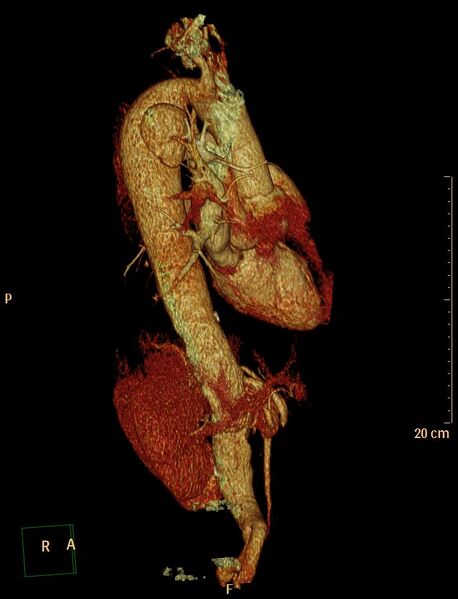 File:Aortic aneurysm and penetrating ulcer (Radiopaedia 23590-23704 3D reconstruction 8).jpg