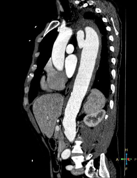 File:Aortic aneurysm and penetrating ulcer (Radiopaedia 23590-23704 C 18).jpg