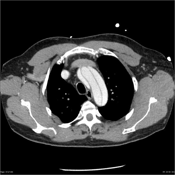 File:Aortic dissection- Stanford A (Radiopaedia 37759-39664 A 10).jpg