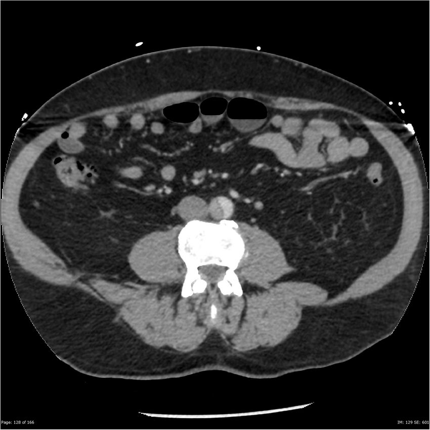 Aortic dissection- Stanford A (Radiopaedia 37759-39664 A 119).jpg