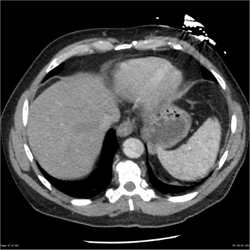 Aortic dissection- Stanford A (Radiopaedia 37759-39664 A 58).jpg