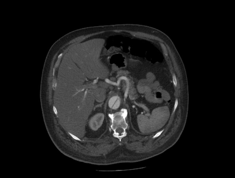 File:Aortic dissection (Radiopaedia 28802-29105 A 44).jpg
