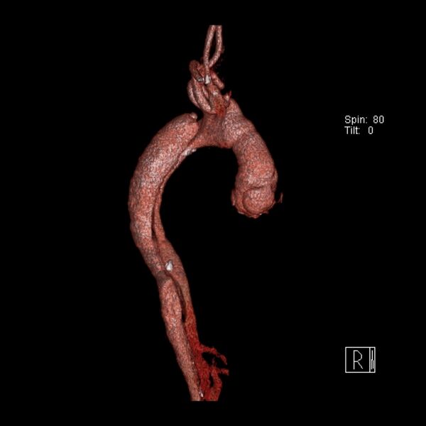 File:Aortic dissection - De Bakey type III - Stanford B (Radiopaedia 21903-21882 3D C+ arterial phase 5).jpg