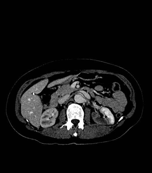 File:Aortic dissection with renal ischemia (Radiopaedia 76573-88338 B 35).jpg