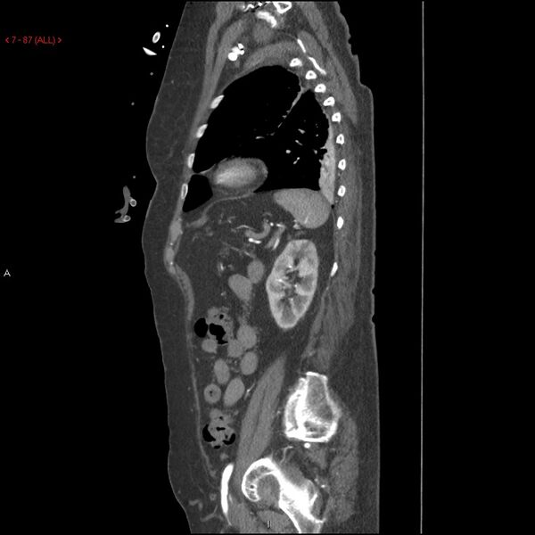 File:Aortic intramural hematoma (Radiopaedia 27746-28001 C 56).jpg