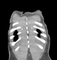 Aortic valve non-coronary cusp thrombus (Radiopaedia 55661-62189 C 75).png