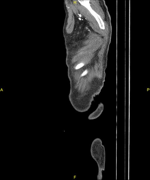 File:Aortoenteric fistula (Radiopaedia 84308-99603 C 334).jpg