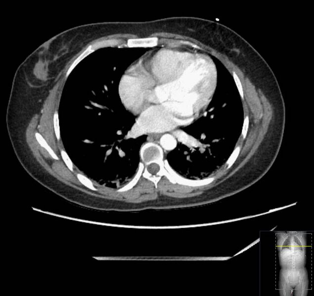 File:Appendicitis (CT angiogram) (Radiopaedia 154713-127660 Axial 191).jpg