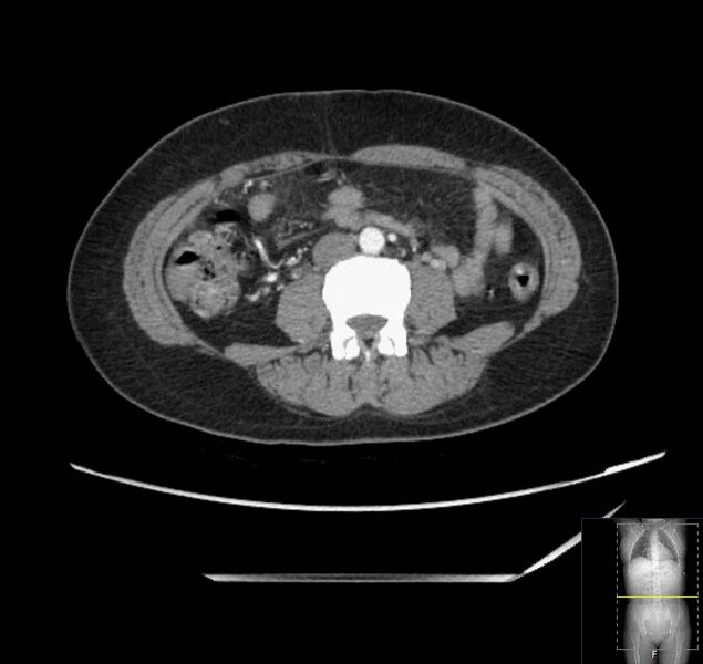 File:Appendicitis (CT angiogram) (Radiopaedia 154713-127660 Axial 65).jpg