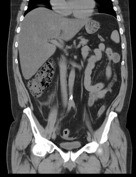File:Appendicitis and giant appendicolith (Radiopaedia 80251-93588 Coronal non-contrast 22).jpg