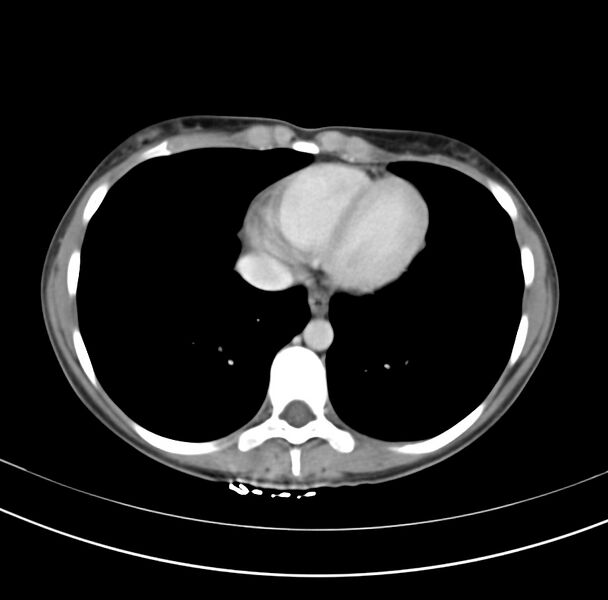 File:Appendicitis and incidental bicornuate uterus (Radiopaedia 22833-22853 B 2).jpg