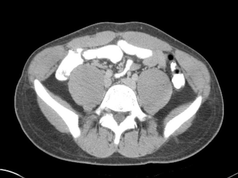 File:Appendicitis and incidental foregut duplication cyst (Radiopaedia 52962-58916 A 58).jpg