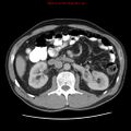 Appendicitis and renal cell carcinoma (Radiopaedia 17063-16760 A 23).jpg