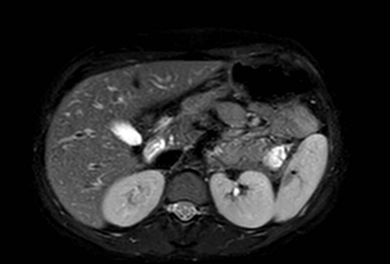 File:Appendicitis in gravida (MRI) (Radiopaedia 89433-106395 Axial T2 SPAIR 23).jpg