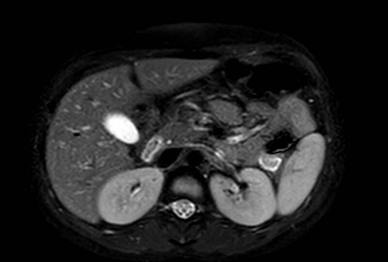 File:Appendicitis in gravida (MRI) (Radiopaedia 89433-106395 Axial T2 SPAIR 24).jpg