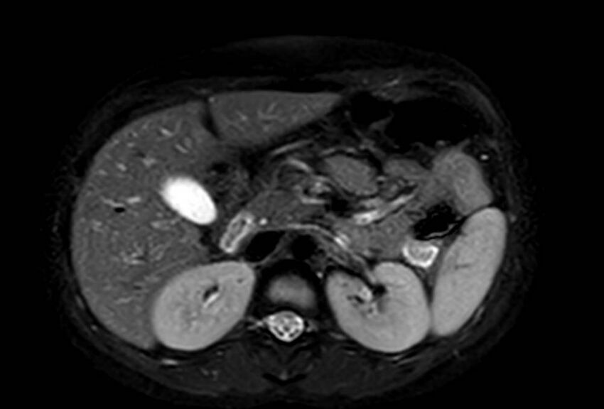 Appendicitis in gravida (MRI) (Radiopaedia 89433-106395 Axial T2 SPAIR 24).jpg