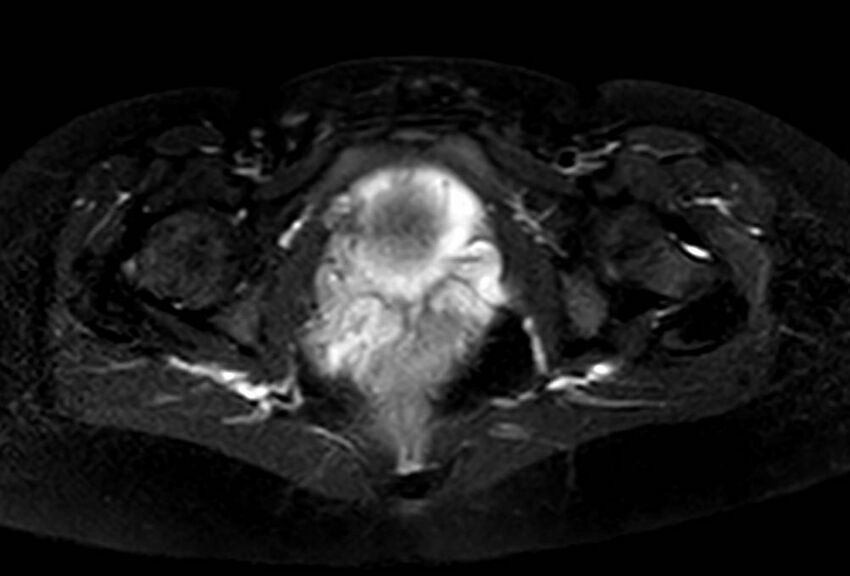 Appendicitis in gravida (MRI) (Radiopaedia 89433-106395 Axial T2 SPAIR 73).jpg