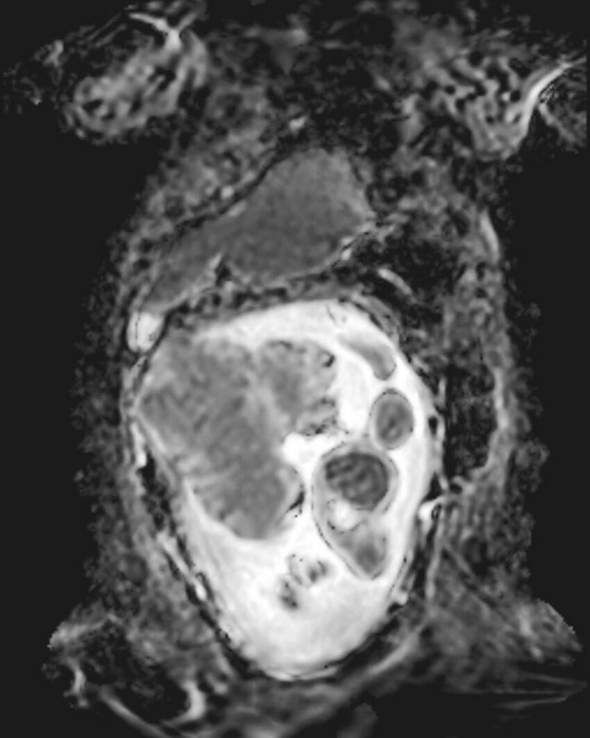 Appendicitis in gravida (MRI) (Radiopaedia 89433-106395 Coronal ADC 16).jpg